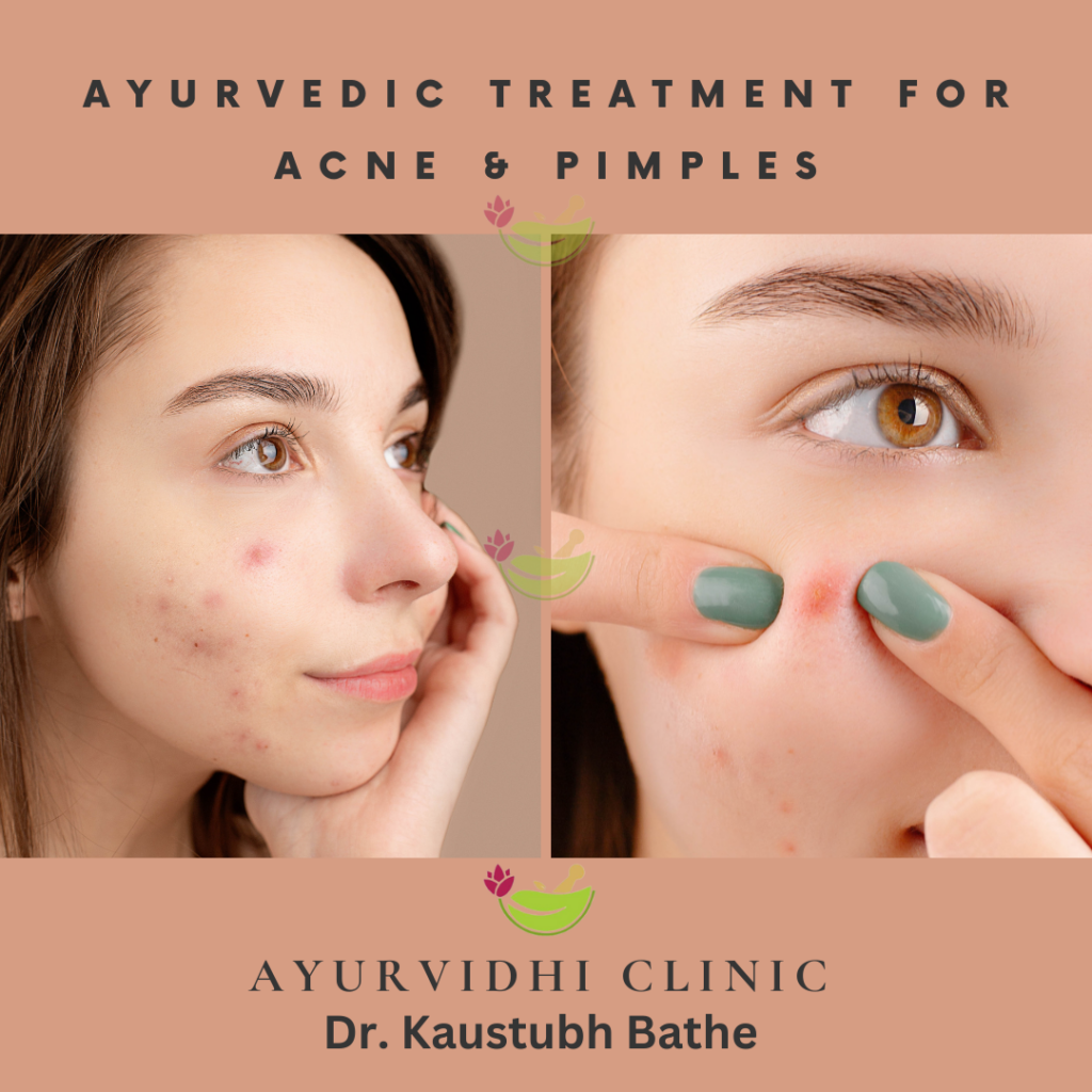 Unlock Clear Skin: Ayurvedic Secrets for Treating Acne Pimples