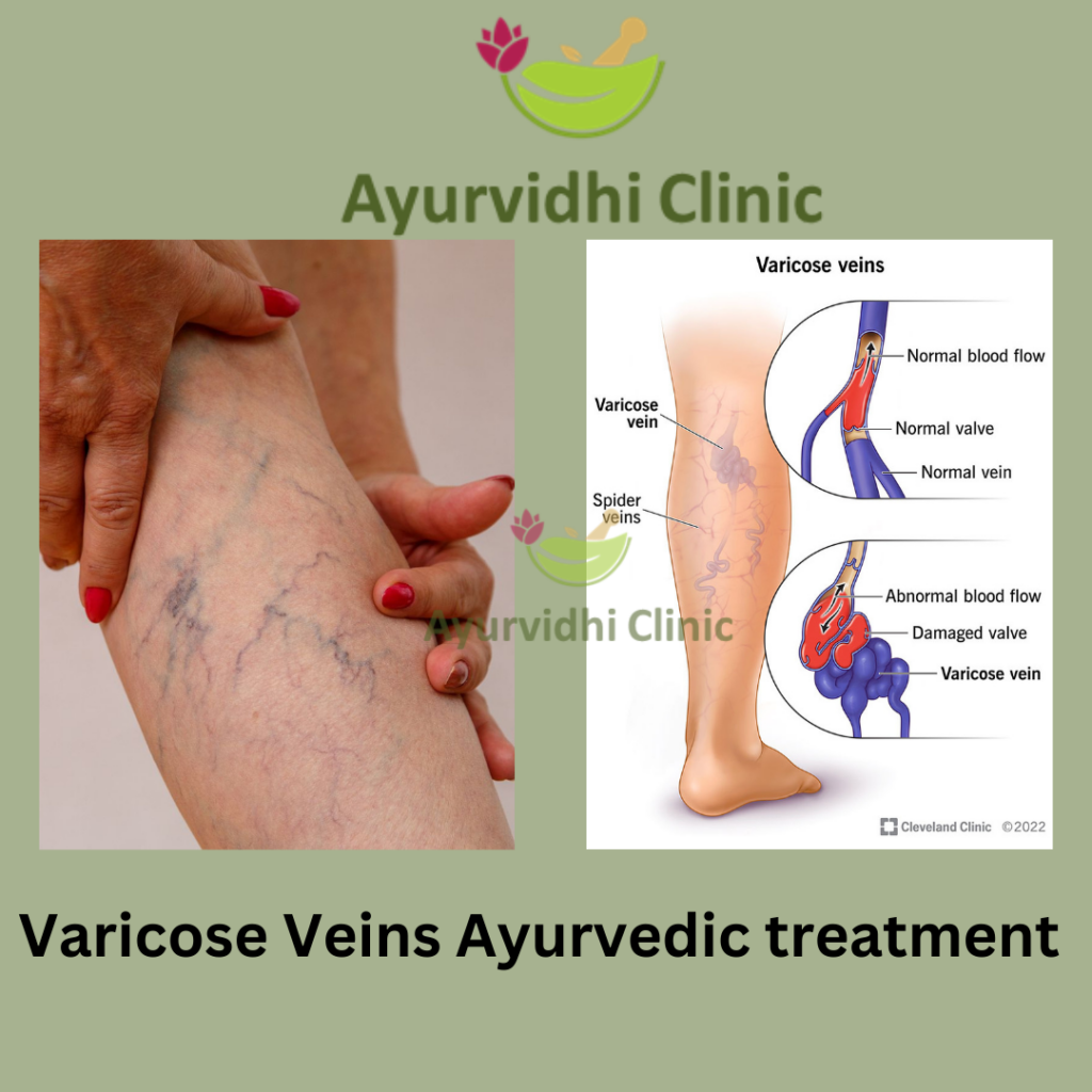 Say Goodbye to Varicose Veins with Ayurvedic Treatments